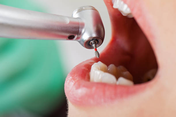 Best Emergency Tooth Extraction in Bodega Bay, CA